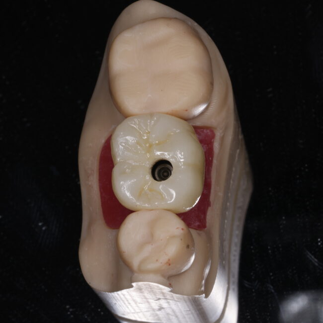 protesis sobre implantes unitaria