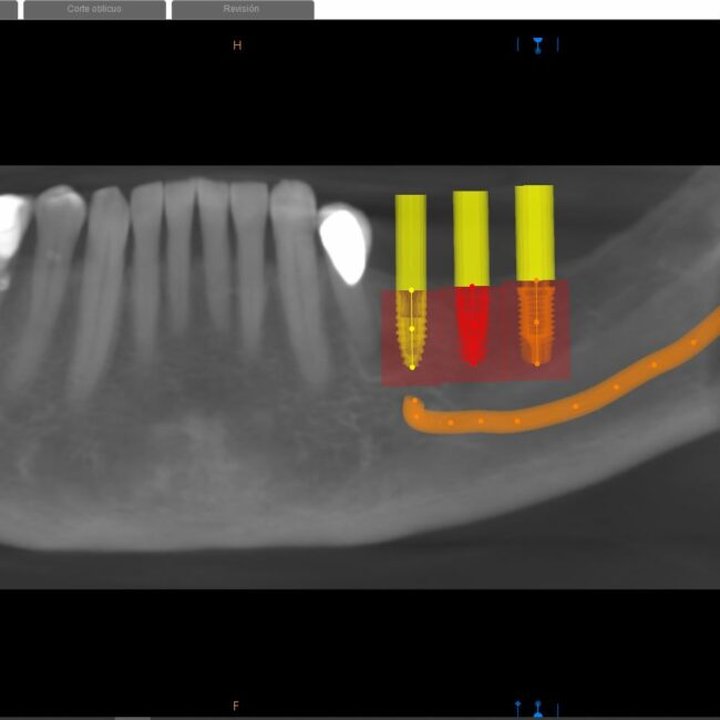 web implantes